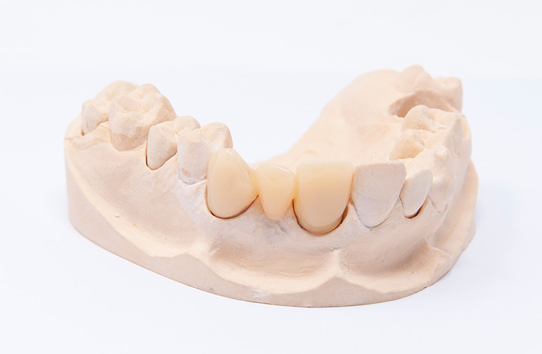 Dentalidea  Fresatura PMMA: la soluzione ideale per protesi dentali  precise e resistenti